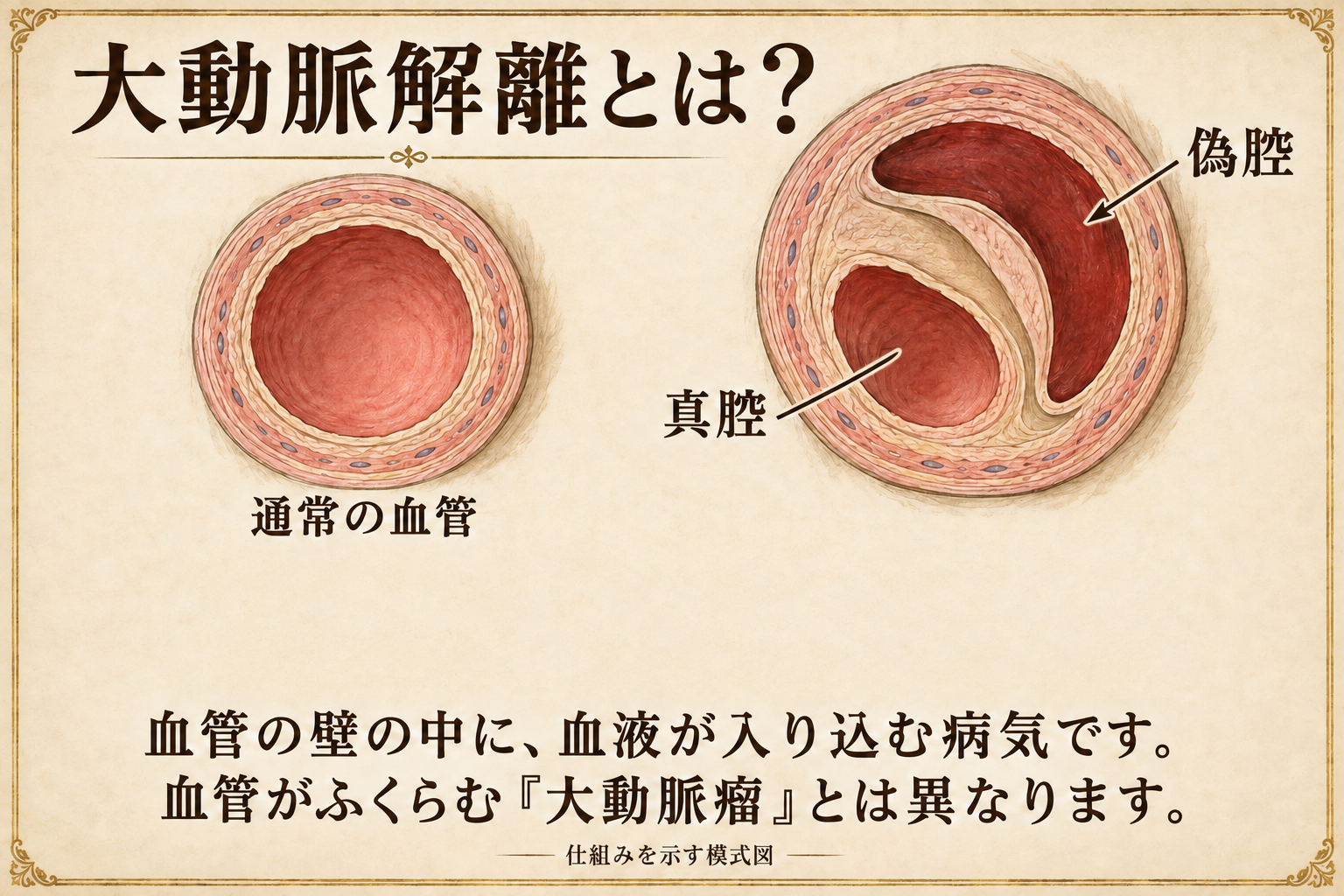 通常の血管と大動脈解離の断面、真腔と偽腔の模式図