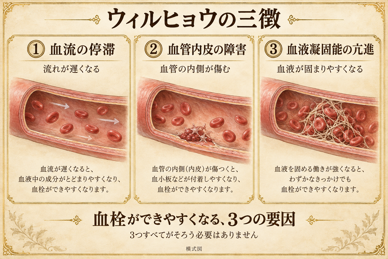 ウィルヒョウの三徴:血流の停滞、血管内皮の障害、血液凝固能の亢進の模式図
